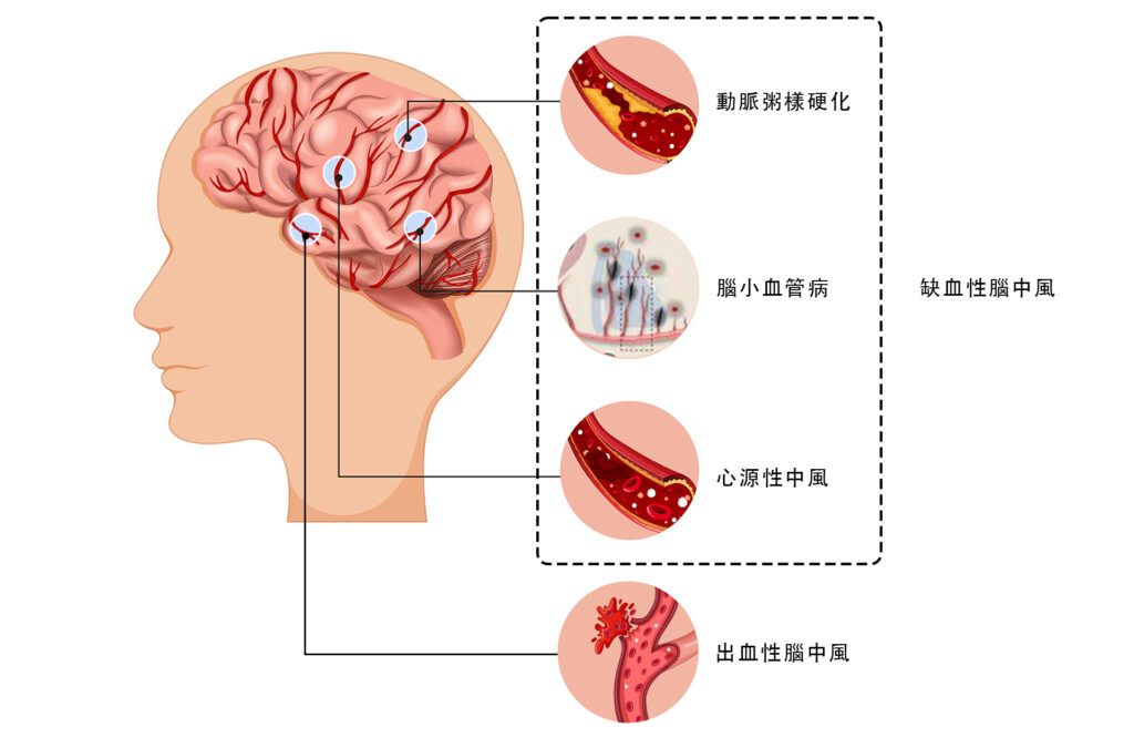 缺血性或出血性中風