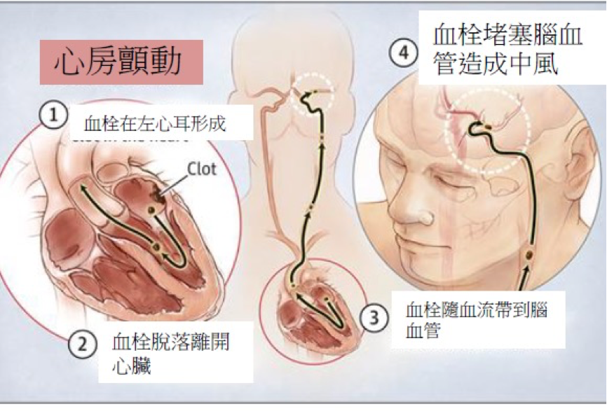 心房顫動