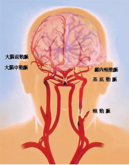 血管粥狀硬化