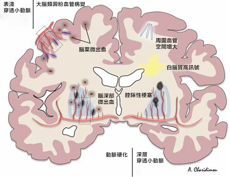 大腦澱粉樣血管病變